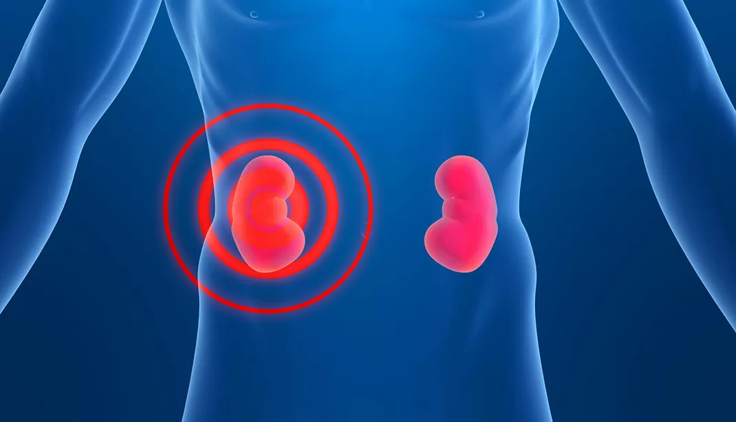 Libretto tumore del rene aimac copertina articolo